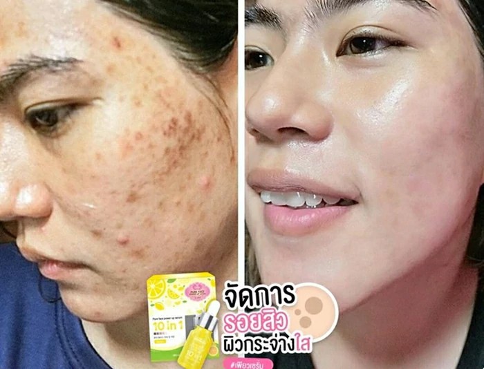 เซรั่มวิตามินซี ยี่ห้อไหนดีที่สุด