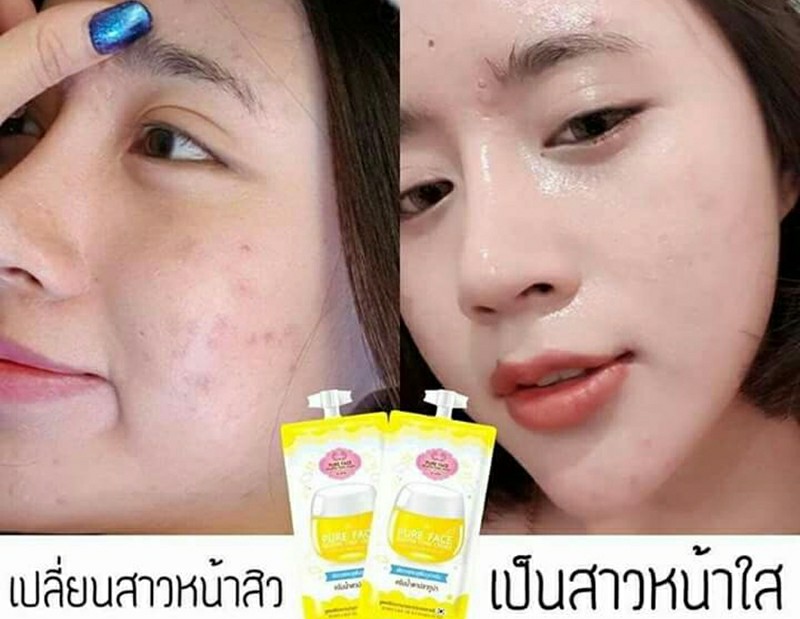 ครีมบํารุงสําหรับคนเป็นสิว